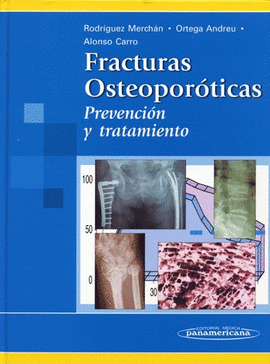 FRACTURAS OSTEOPOROTICAS PREVENCION Y TRATAMIENTO
